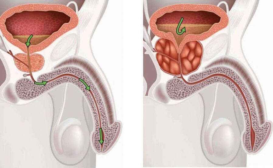 Informatiounen iwwert d'Krankheet prostatitis