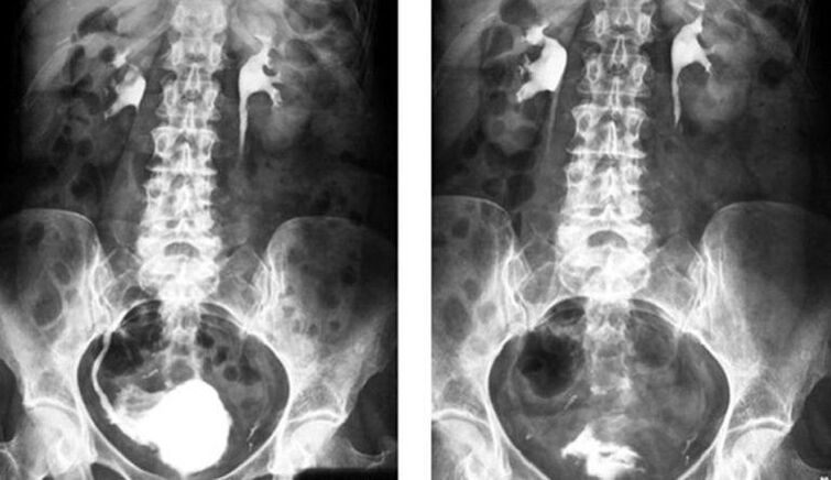 Urographie fir Diagnos vun Prostatitis