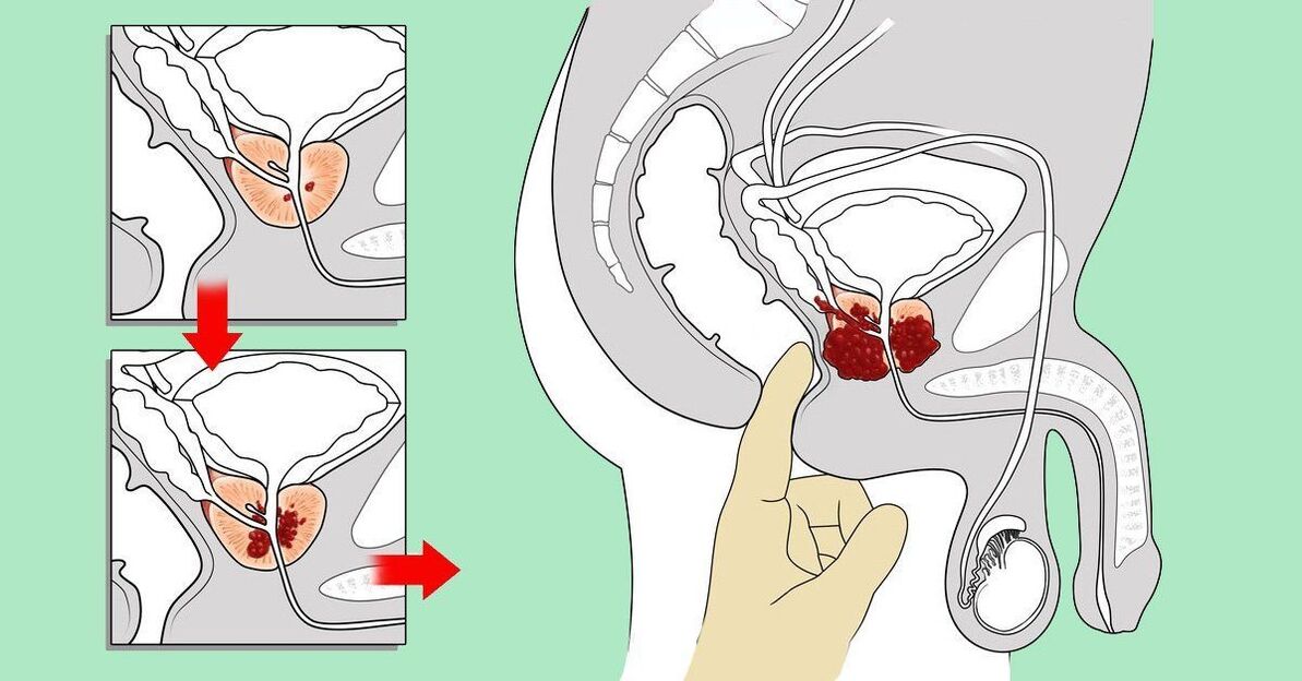 wéi d'Prostata masséieren